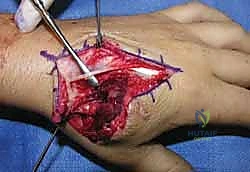 خطوة جراحية 4