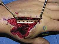 خطوة جراحية 3