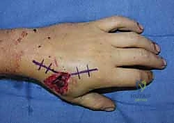 صورة توضيحية لـ كسور عظام اليد المشطية: دليل شامل للعلاج الجراحي مع الأستاذ الدكتور محمد هطيف