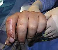 خطوة جراحية 5