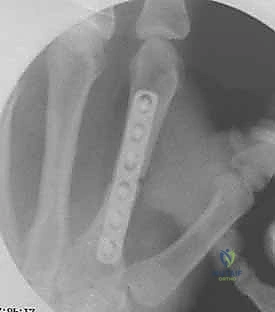 Intraoperative Surgical Step