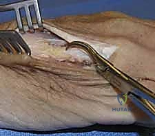 صورة توضيحية لـ كسور عظام اليد المشطية: دليل شامل للعلاج الجراحي مع الأستاذ الدكتور محمد هطيف