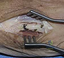 صورة توضيحية لـ كسور عظام اليد المشطية: دليل شامل للعلاج الجراحي مع الأستاذ الدكتور محمد هطيف