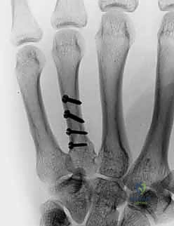 تثبيت نخاعي 3