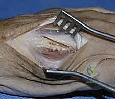 صورة توضيحية لـ كسور عظام اليد المشطية: دليل شامل للعلاج الجراحي مع الأستاذ الدكتور محمد هطيف