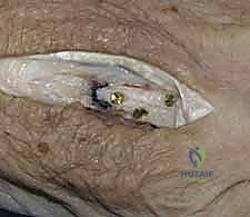 تثبيت نخاعي 2