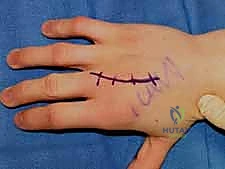 صورة توضيحية لـ كسور عظام اليد المشطية: دليل شامل للعلاج الجراحي مع الأستاذ الدكتور محمد هطيف