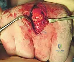 Illustration of treatment of metacarpal fractures - Dr. Mohammed Hutaif