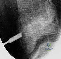 صورة توضيحية لـ تثبيت صفيحة النمو عن طريق الجلد: حل دقيق لتفاوت طول الأطراف لدى الأطفال مع الأستاذ الدكتور محمد هطيف