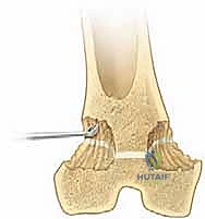 صورة توضيحية لـ تثبيت صفيحة النمو عن طريق الجلد: حل دقيق لتفاوت طول الأطراف لدى الأطفال مع الأستاذ الدكتور محمد هطيف