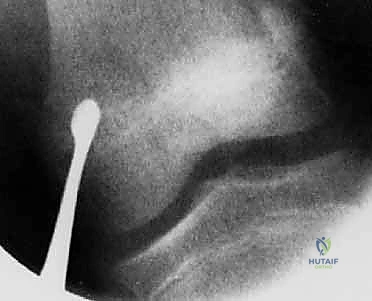 التخطيط الجراحي لتثبيت صفيحة النمو