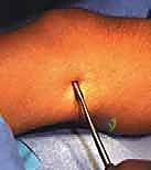 الأسباب المؤدية إلى تفاوت طول الأطراف لدى الأطفال