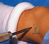 خيارات علاج تفاوت طول الأطراف