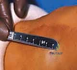 التشخيص الإشعاعي لتفاوت طول الأطراف