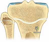 صورة توضيحية لـ تثبيت صفيحة النمو عن طريق الجلد: حل دقيق لتفاوت طول الأطراف لدى الأطفال مع الأستاذ الدكتور محمد هطيف