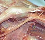 صورة توضيحية لـ تثبيت صفيحة النمو عن طريق الجلد: حل دقيق لتفاوت طول الأطراف لدى الأطفال مع الأستاذ الدكتور محمد هطيف