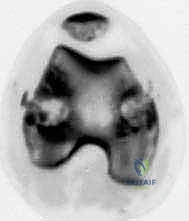 صورة توضيحية لـ تثبيت صفيحة النمو عن طريق الجلد: حل دقيق لتفاوت طول الأطراف لدى الأطفال مع الأستاذ الدكتور محمد هطيف