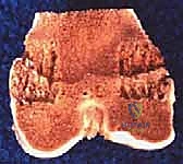 تثبيت صفيحة النمو عن طريق الجلد: حل دقيق لتفاوت طول الأطراف لدى الأطفال مع الأستاذ الدكتور محمد هطيف