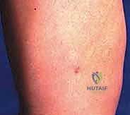 صورة توضيحية لـ تثبيت صفيحة النمو عن طريق الجلد: حل دقيق لتفاوت طول الأطراف لدى الأطفال مع الأستاذ الدكتور محمد هطيف