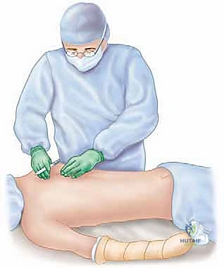 تثبيت لوح الكتف بالأسلاك والشرائح