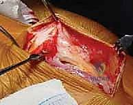 العناية ما بعد جراحة الكتف