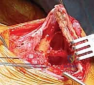 أسباب تطاير لوح الكتف