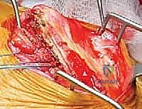 استعادة حركة الذراع تدريجياً