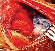 حالات ضعف عضلات الكتف