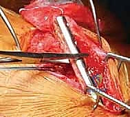 استخدام الرقاع العظمية في الجراحة