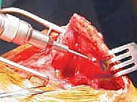 التشخيص الدقيق لحالات الكتف