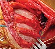 التحضير لجراحة تثبيت الكتف