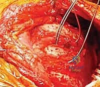 مفهوم دمج لوح الكتف