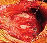 تثبيت الكتف الصدري (Scapulothoracic Arthrodesis): دليل شامل للمرضى مع الأستاذ الدكتور محمد هطيف