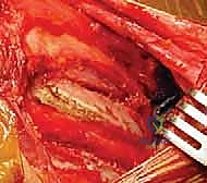 العلاج التحفظي مقابل الجراحي