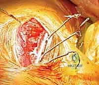 صورة توضيحية لـ تثبيت الكتف الصدري (Scapulothoracic Arthrodesis): دليل شامل للمرضى مع الأستاذ الدكتور محمد هطيف