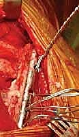 صورة توضيحية لـ تثبيت الكتف الصدري (Scapulothoracic Arthrodesis): دليل شامل للمرضى مع الأستاذ الدكتور محمد هطيف