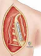 صورة توضيحية لـ تثبيت الكتف الصدري (Scapulothoracic Arthrodesis): دليل شامل للمرضى مع الأستاذ الدكتور محمد هطيف