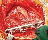 صورة توضيحية لـ تثبيت الكتف الصدري (Scapulothoracic Arthrodesis): دليل شامل للمرضى مع الأستاذ الدكتور محمد هطيف