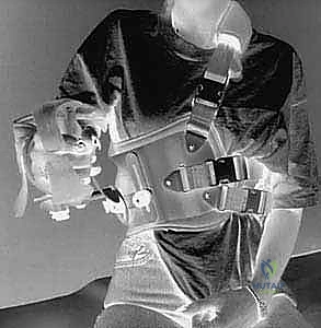 صورة توضيحية لـ تثبيت الكتف الصدري (Scapulothoracic Arthrodesis): دليل شامل للمرضى مع الأستاذ الدكتور محمد هطيف