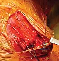 Illustration of surface of the scapula - Dr. Mohammed Hutaif