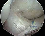 Intraoperative Surgical Step