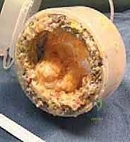 Surgical technique step for Arthroscopic Synovectomy