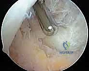 Arthroscopic Synovectomy: An Intraoperative Masterclass in Knee Joint Preservation
