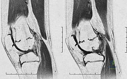 التصوير بالرنين المغناطيسي وتحديد خريطة العائق العظمي