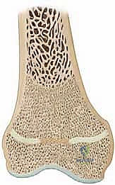 الخطوة الجراحية الثانية: استئصال العائق باستخدام المثقاب الدقيق