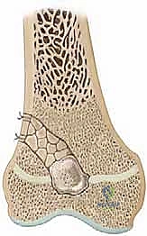 إزالة العائق العظمي من صفيحة النمو: استعادة النمو الطبيعي وتصحيح التشوهات للأطفال