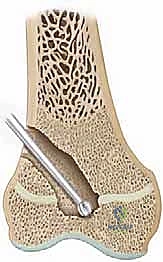 الخطوة الجراحية الثالثة: التأكد من إزالة العائق ورؤية الغضروف السليم