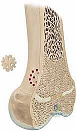 وضع المادة الفاصلة لمنع عودة العائق العظمي