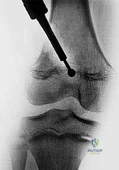 صورة توضيحية لـ إزالة العائق العظمي من صفيحة النمو: استعادة النمو الطبيعي وتصحيح التشوهات للأطفال