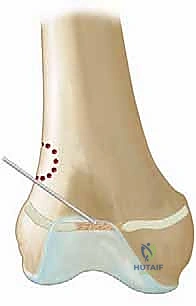 مقدمة عن تشريح صفيحة النمو وتأثير العائق